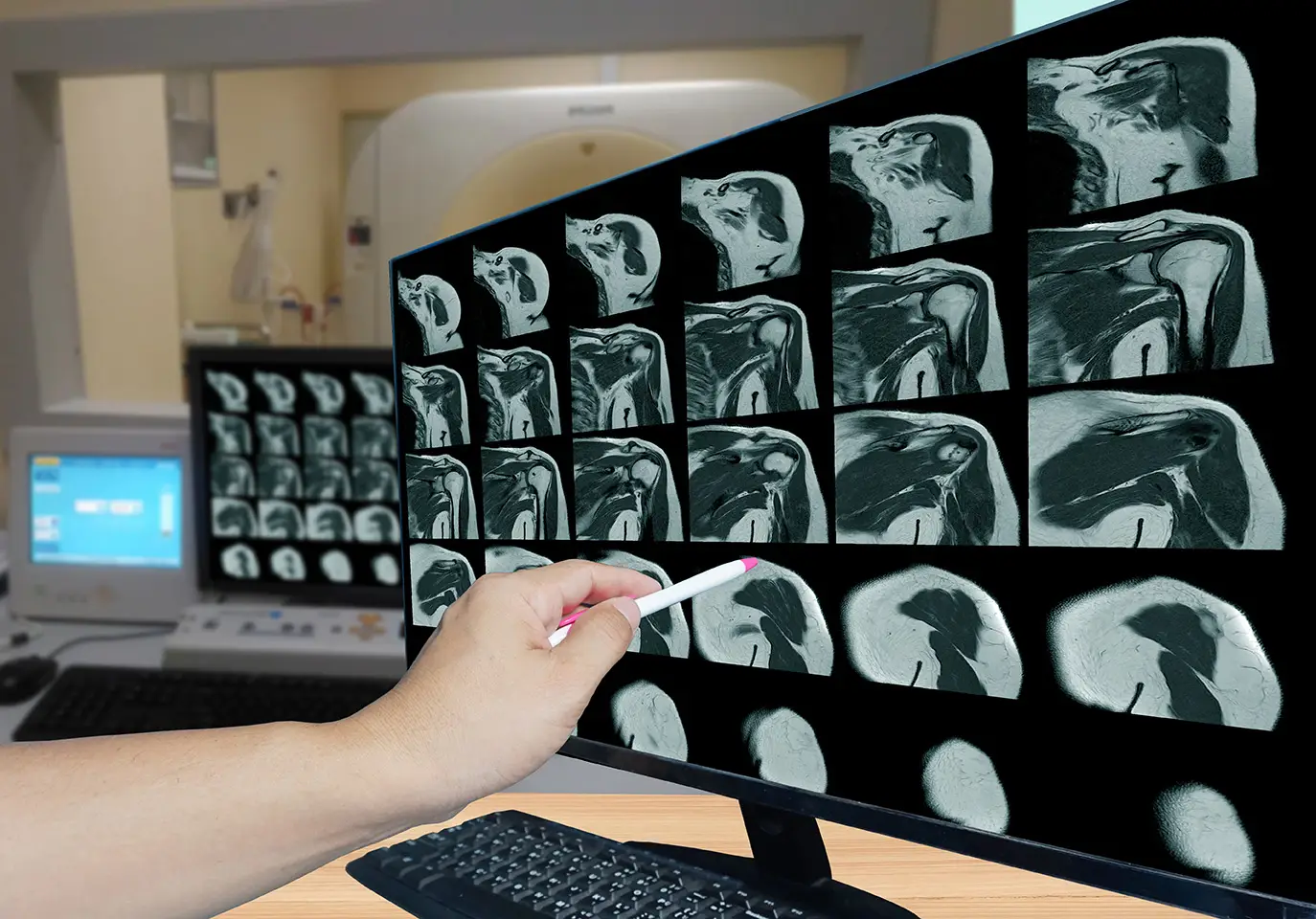 Shoulder MRI showing a possible rotator cuff injury after a car accident